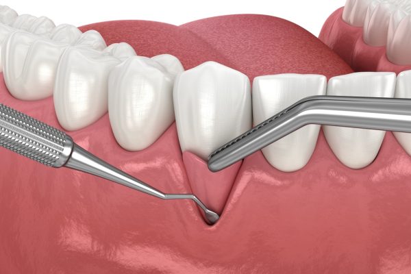 soft tissue grafting