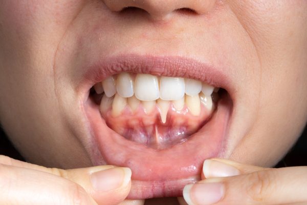 receding gums from gum disease