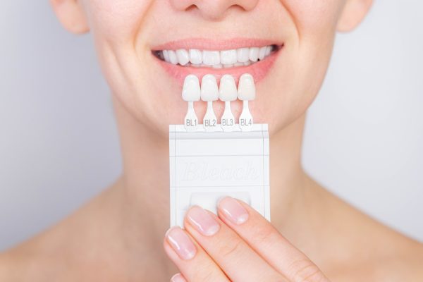 dental veneers