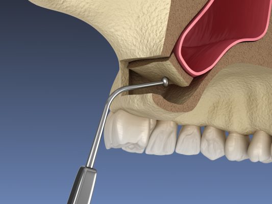 sinus lift