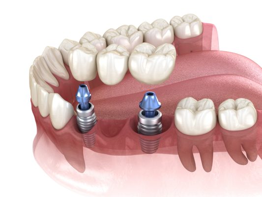 dental implants