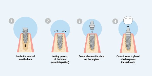 dental implant process