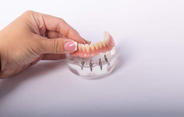 all-on-4 dental implants