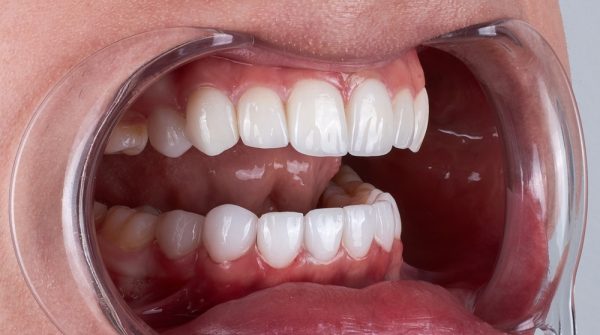 cosmetic dentistry oral appliance